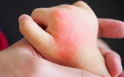 3 Most Common Allergic Reactions in Kids