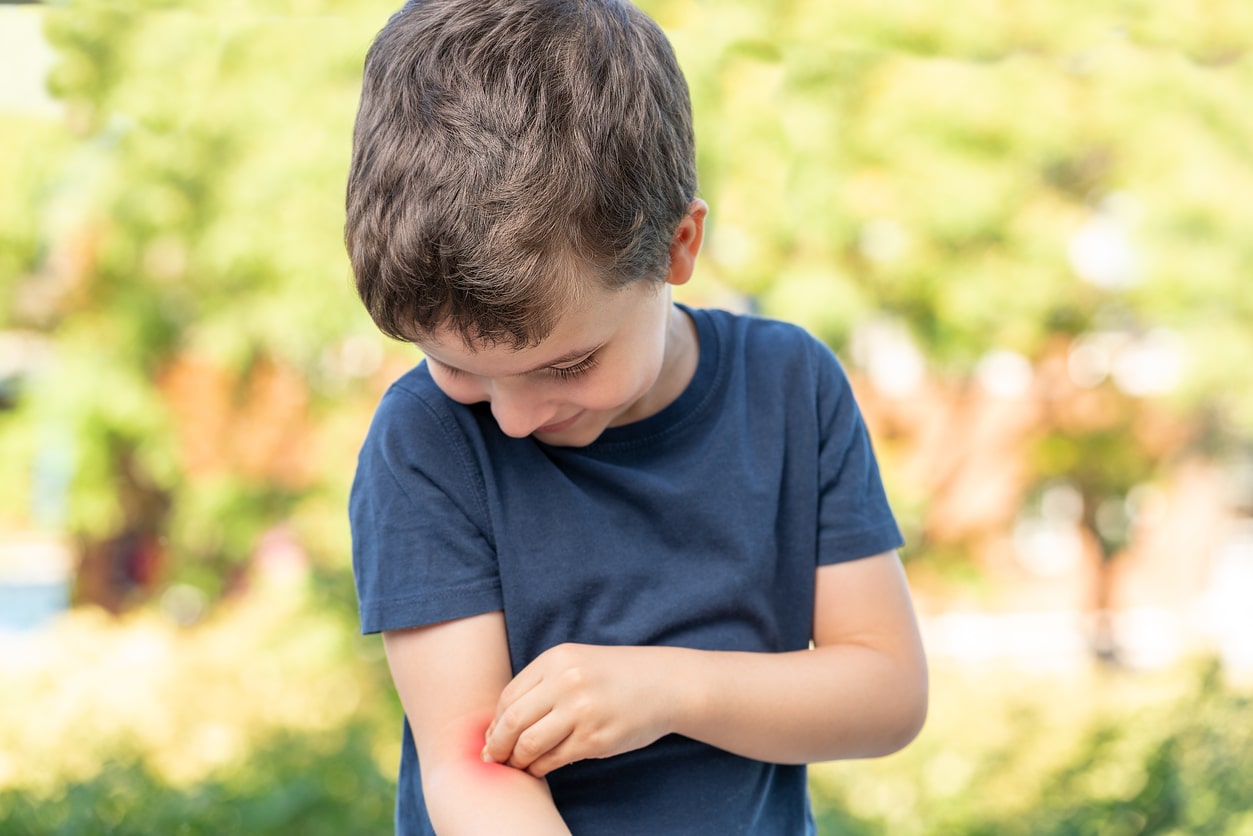 treating-bee-stings-and-bug-bites-in-kids-kidsstreet