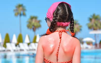 Most Common Minor Burns and Sunburns in Kids